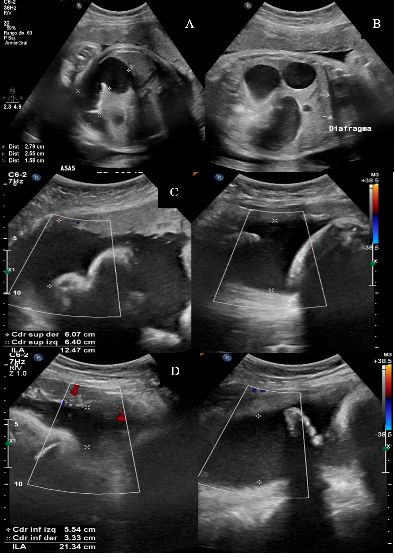 Ultrasonido prenatal a las 36 Semanas de gestación A) Asas yeyunales dilatadas con contenido intestinal de baja ecogenicidad B).  Ultrasonido con signo de la triple burbuja. C). Cuantificación del líquido amniótico con la técnica de cuatro cuadrantes, índice de líquido amniótico en el límite superior. 